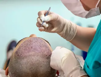 Hair Transplant (representative image)